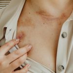 Nowa nadzieja dla ran, które nie chcą się goić — fala uderzeniowa ESWT w praktyce